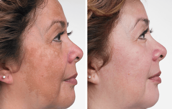 antes-e-depois-da-remoção-de-melasma-a-laser-1